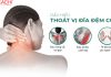 Khám Phá Kịch Bản Tập Luyện Thoát Vị Đĩa Đệm Cổ An Toàn Và Hiệu Quả
